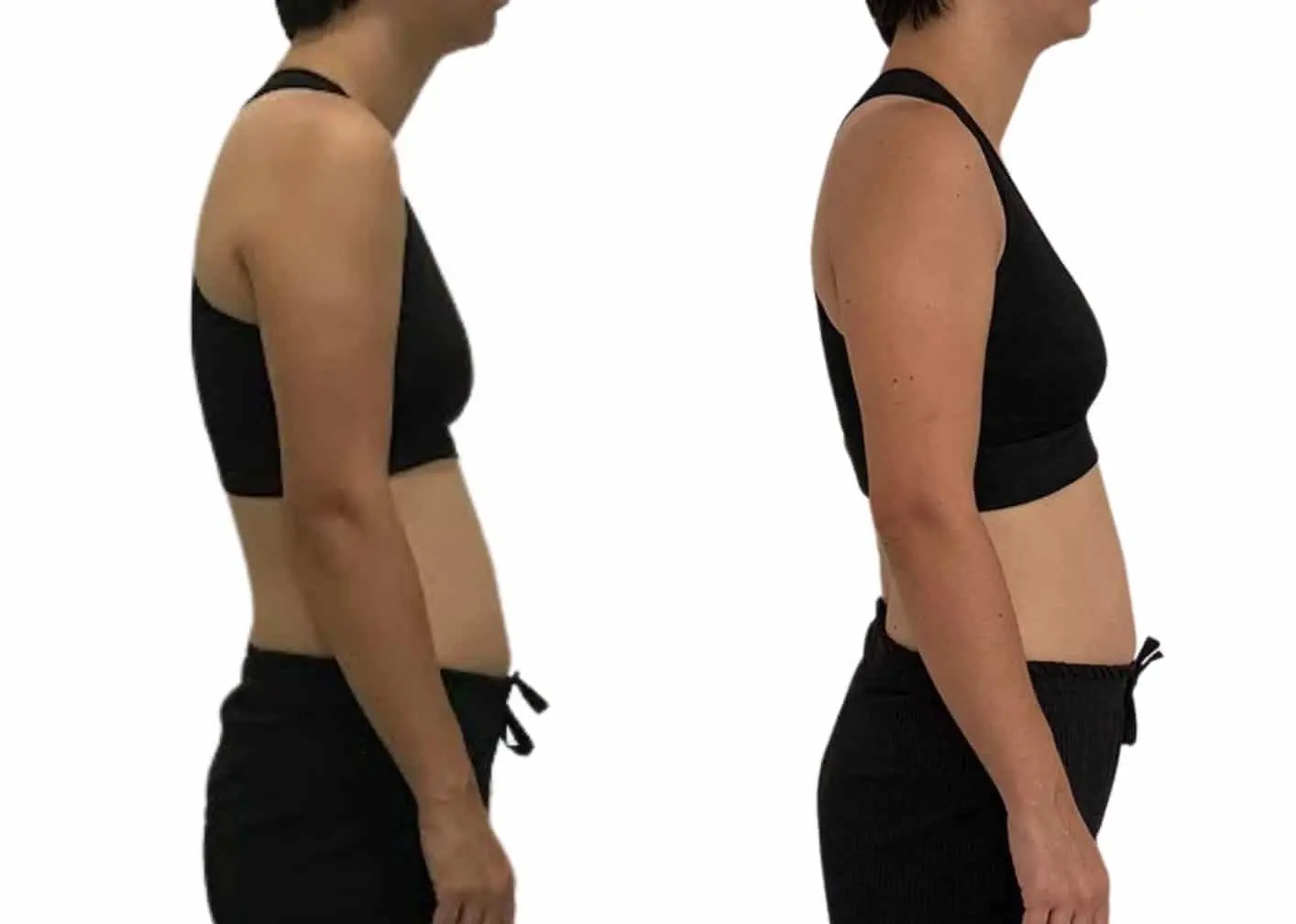 Fim dos ombros fechados com reversão de cifose e atenuação de lordose