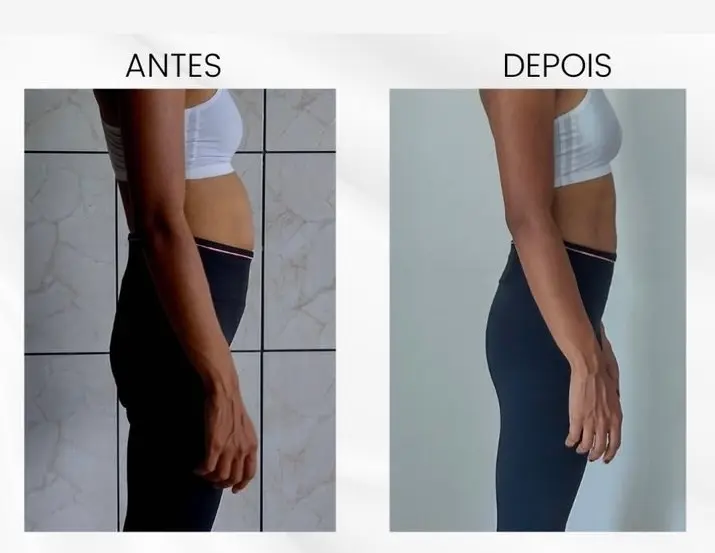 Reversão de diástase grave com fortalecimento de core